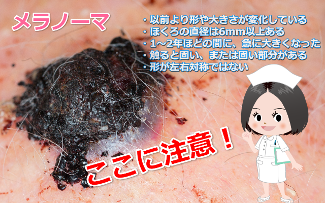 メラノーマ写真